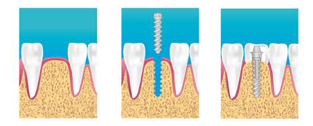 implant dentaire Voisins-le-Bretonneux